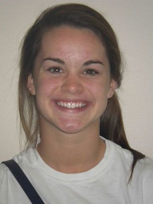 Invisalign: Case 2 - After