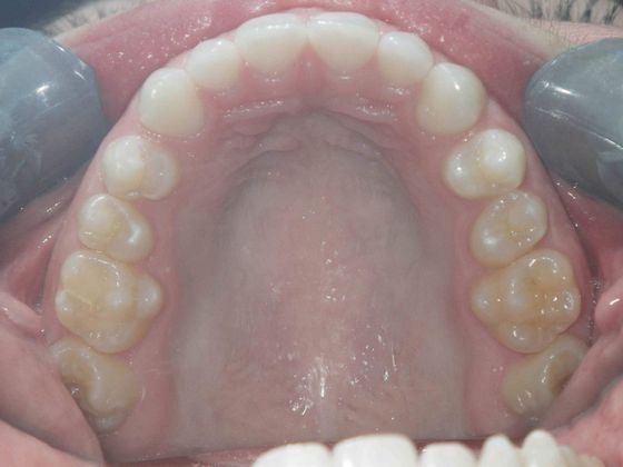 Invisalign: Case 2 - After