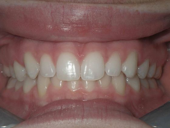 Invisalign: Case 2 - After