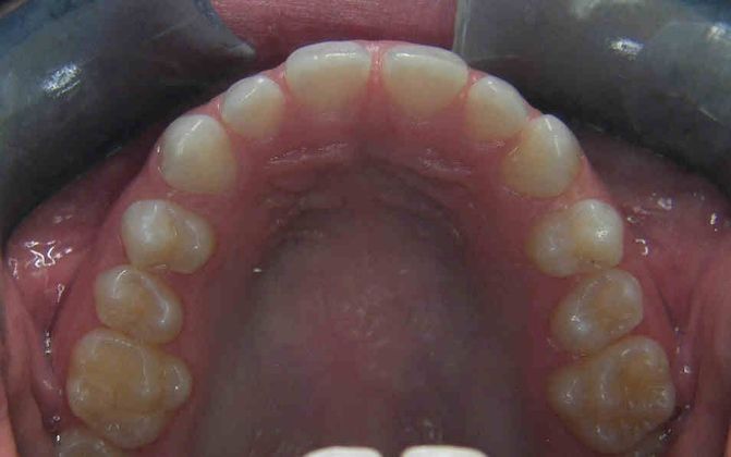 Invisalign: Case 2 - Before