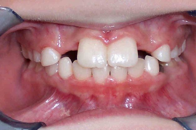 Orthodontic and Implant Cases