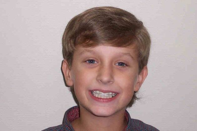 Orthodontic and Implant Case 1 - Before