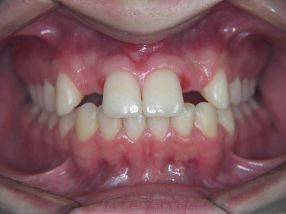 Orthodontic and Implant: Case 1 - Before