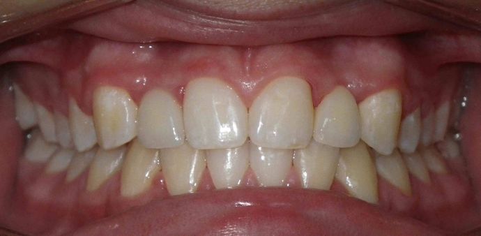 Orthodontic and Implant: Case 2 - After