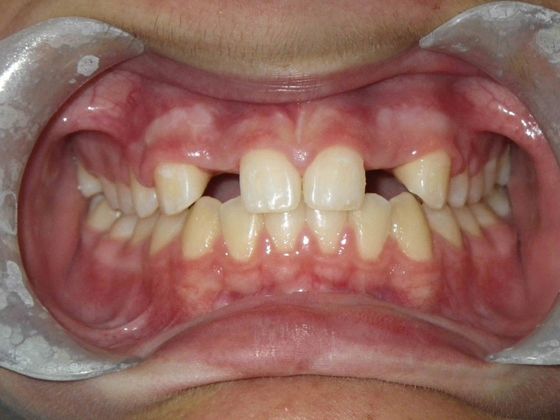 Orthodontic and Implant Case 2 - After