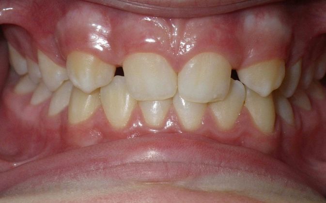 Orthodontic and Implant Case 2 - Before