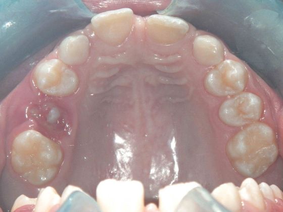 Orthodontic and Implant: Case 3 - Before