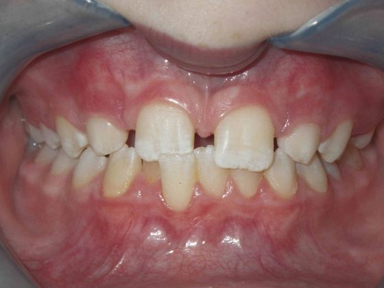 Orthodontic and Implant Case 3 - Before