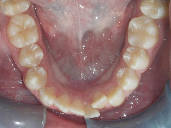 Orthodontic and Implant: Case 3 - Before