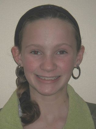 Orthodontic and Implant: Case 3 - Before