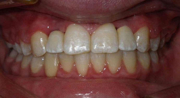 Orthodontic and Implant Case 3 - After