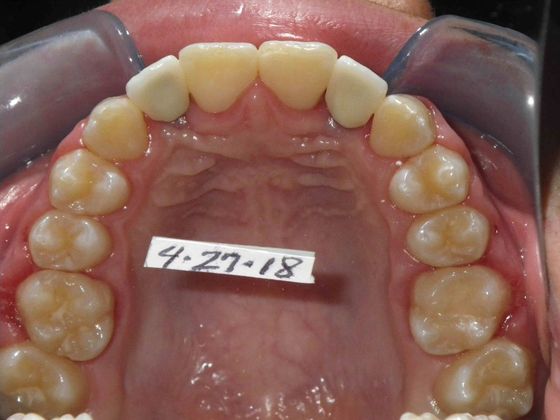 Orthodontic and Implant: Case 3 - After