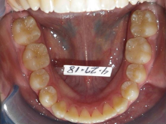 Orthodontic and Implant: Case 3 - After