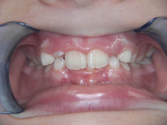 Orthodontics: Case 2 - Before