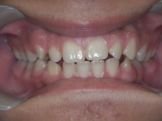 Orthodontics: Case 3 - Before