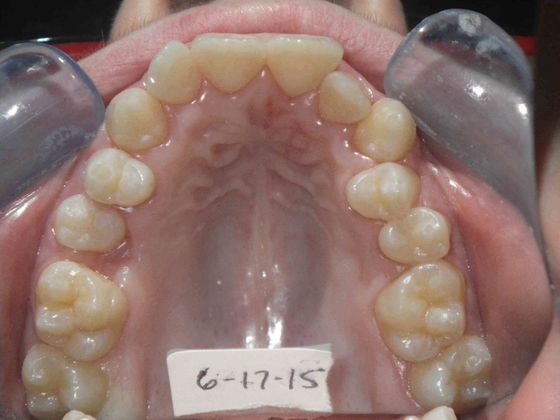 Orthodontics: Case 4 - Before