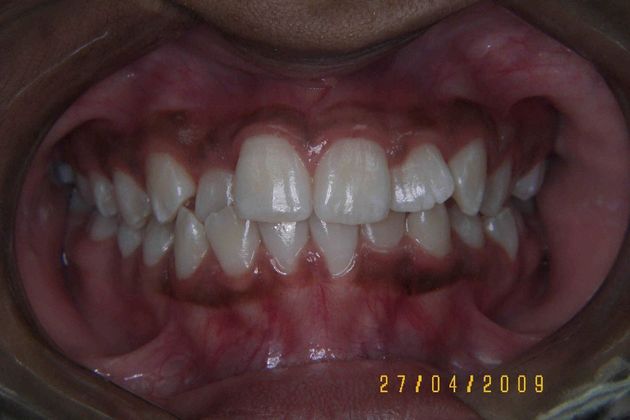 Orthodontics Case 8 - Before