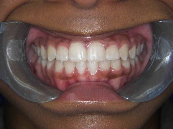 Orthodontics Case 8 - After