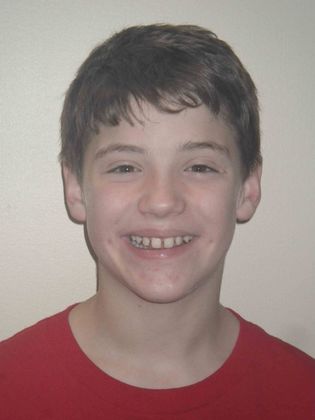 Orthodontics: Case 5 - Before