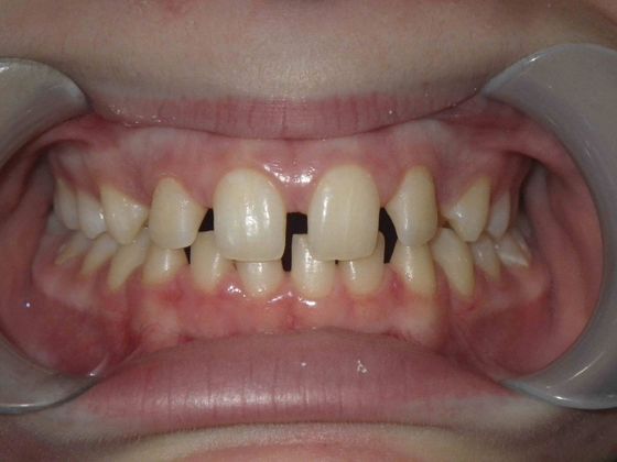Orthodontics: Case 5 - Before
