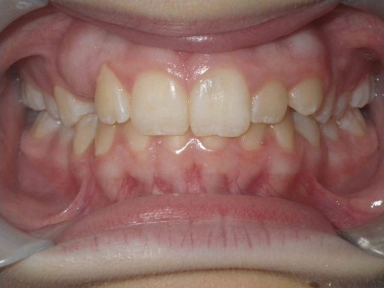Orthodontics Case 11 - Before