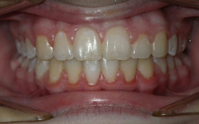 Orthodontics Case 11 - After
