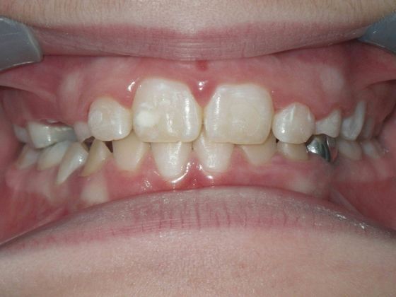 Orthodontics Case 13 - Before
