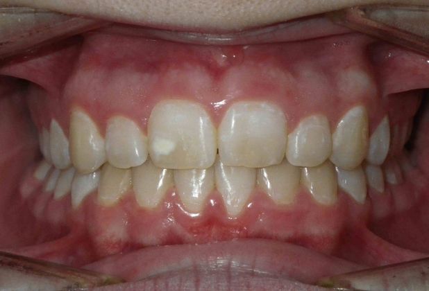 Orthodontics Case 13 - After