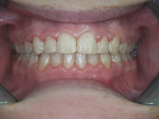 Orthodontics Case 14 - After