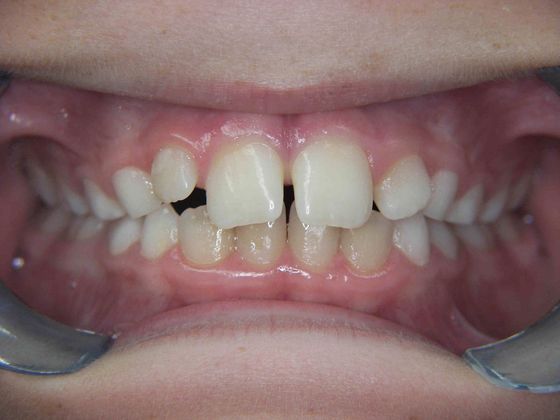 Orthodontics Case 15 - Before