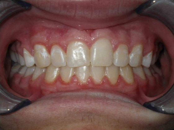 Orthodontics Case 15 - After