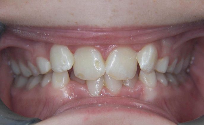 Orthodontic treatment in Phases Case 1 - Before
