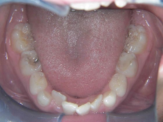 Orthodontic treatment in Phases: Case 1 - Before