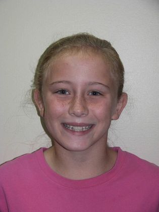 Orthodontic treatment in Phases: Case 1 - Before