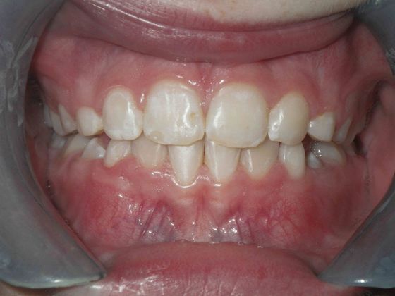 Orthodontic treatment in Phases Cases