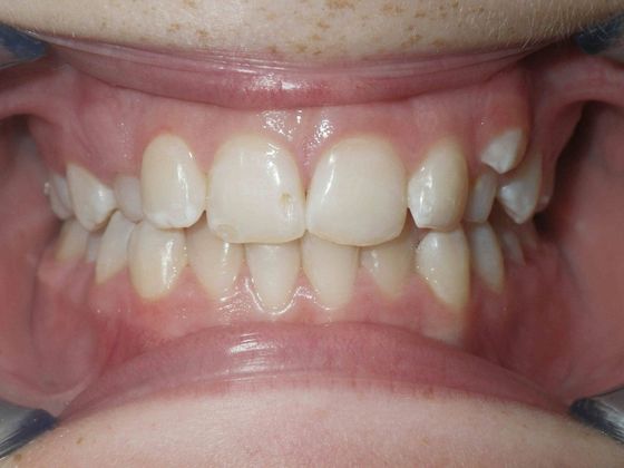 Orthodontic treatment in Phases: Case 1 - Before