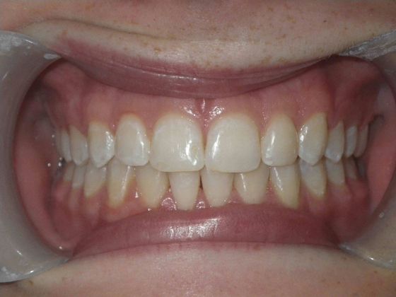 Orthodontic treatment in Phases: Case 1 - After
