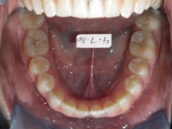 Orthodontic treatment in Phases: Case 1 - After
