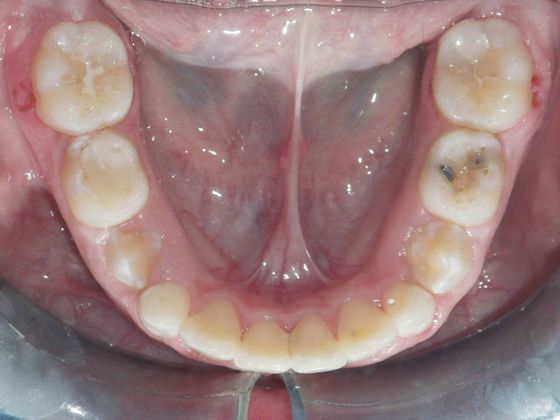 Orthodontic treatment in Phases: Case 1 - After