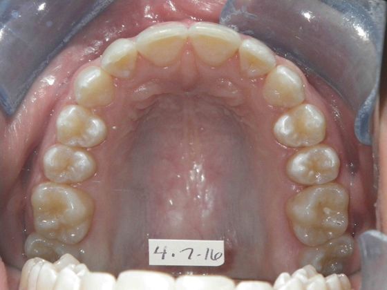 Orthodontic treatment in Phases: Case 1 - Before