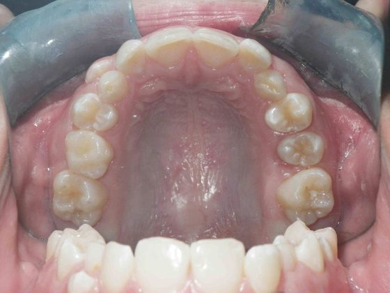 Orthodontic treatment in Phases: Case 1 - After