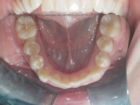 Orthodontic treatment in Phases: Case 1 - Before