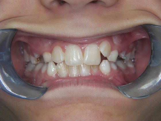Orthodontic treatment in Phases Case 2 - Before