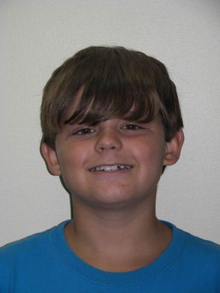 Orthodontic treatment in Phases: Case 2 - Before