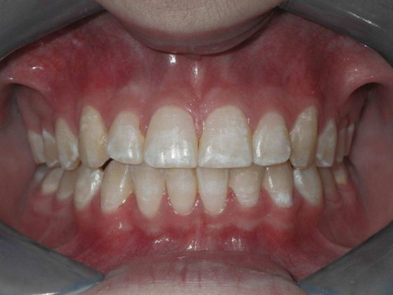 Orthodontic treatment in Phases Case 2 - After