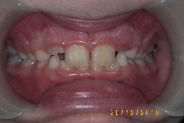 Orthodontic treatment in Phases: Case 3 - Before