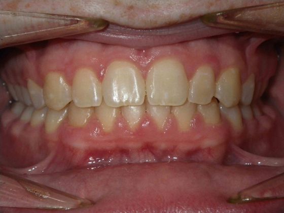 Orthodontic treatment in Phases: Case 3 - After