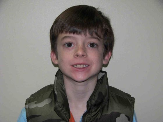 Orthodontic treatment in Phases: Case 3 - Before