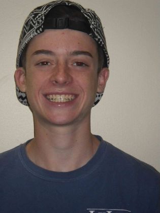 Orthodontic treatment in Phases: Case 3 - After