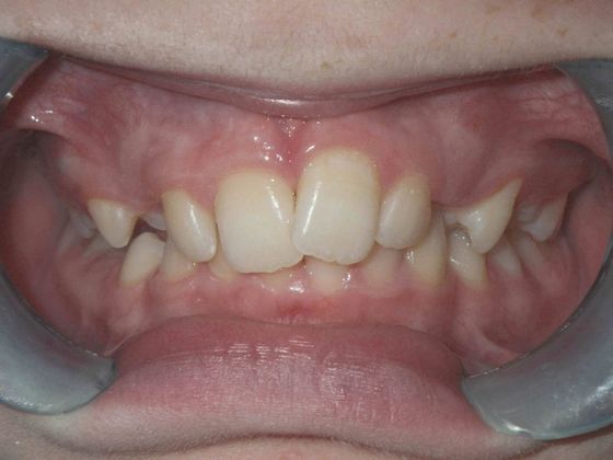Orthodontic treatment in Phases: Case 4 - Before
